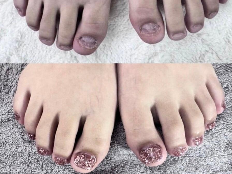 福岡市博多リプロネイル式深爪矯正専門サロンルソア